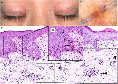 Case report: Iatrogenic tattoos caused by skin marking pen in a postoperative patient